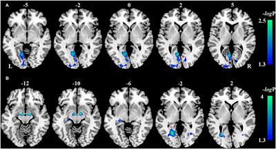 Frontiers Brain Gray Matter Atrophy And Functional Connectivity